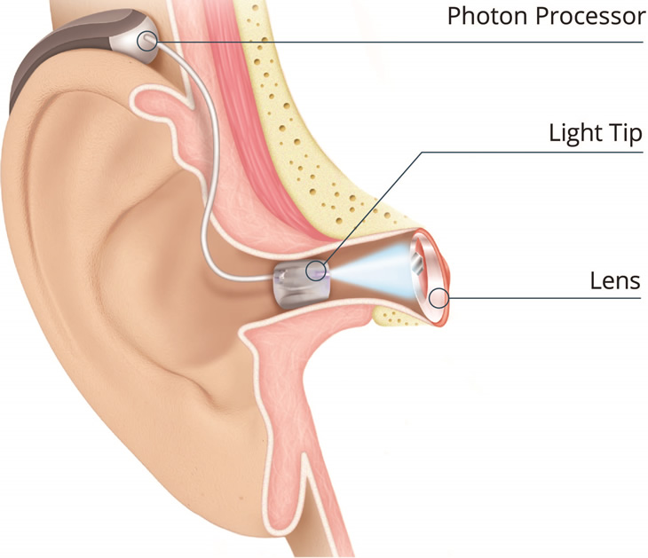 earlens-hearing-aid-processor